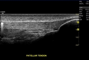 ml6-15patellart-crop.jpg