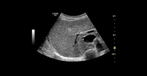 Dr. Weskott -  How and Why to Use CEUS for Liver Studies 