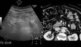 LOGIQ E9 Bx Retroperitoneal and Renal Carcinoma