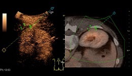 LOGIQ E9 Bx Superficial Kidney Tumor with Contrast