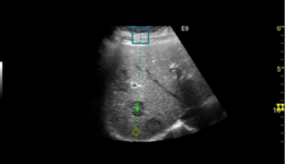 LOGIQ E9 XDclear 2.0 US Guided Ablation in Management of ...