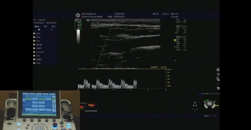 LOGIQ P9/P7- Auto Optimize B-mode and Doppler